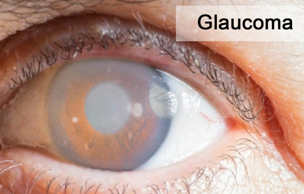 glaucoma causes