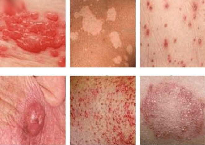 Skin Disorders Autoimmune