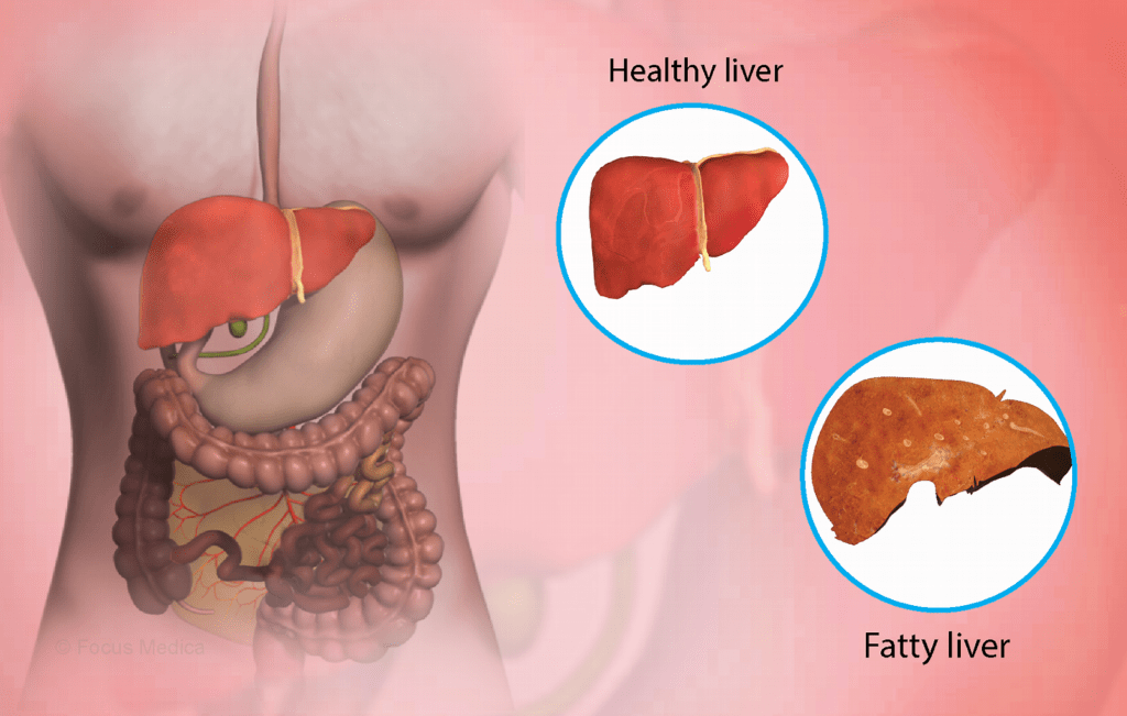 fatty liver disease life expectancy