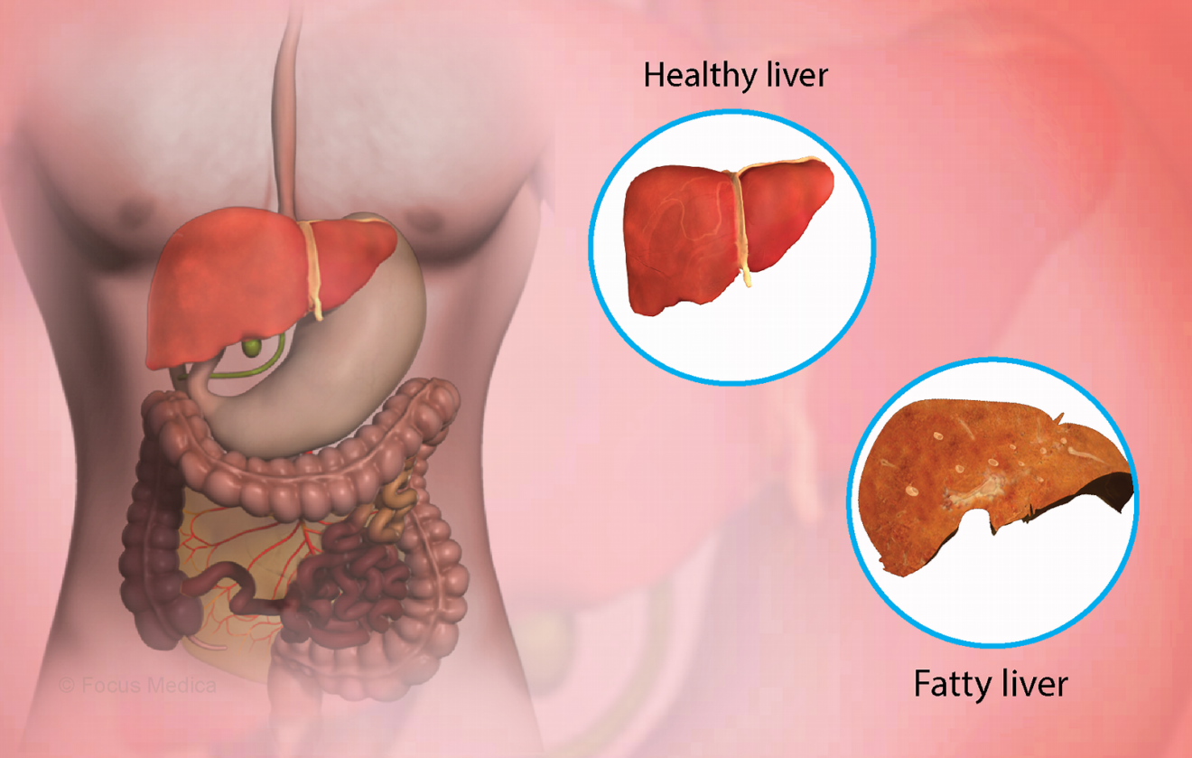 fatty-liver-disease-life-expectancy-the-mealbetix-lifestyle-meal